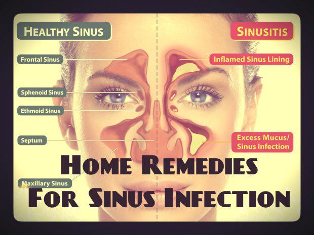 home remedies for sinus infection